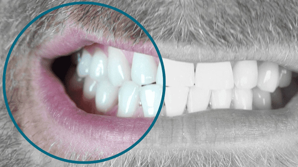 What is Bruxism (Teeth Grinding) and How is it Treated?