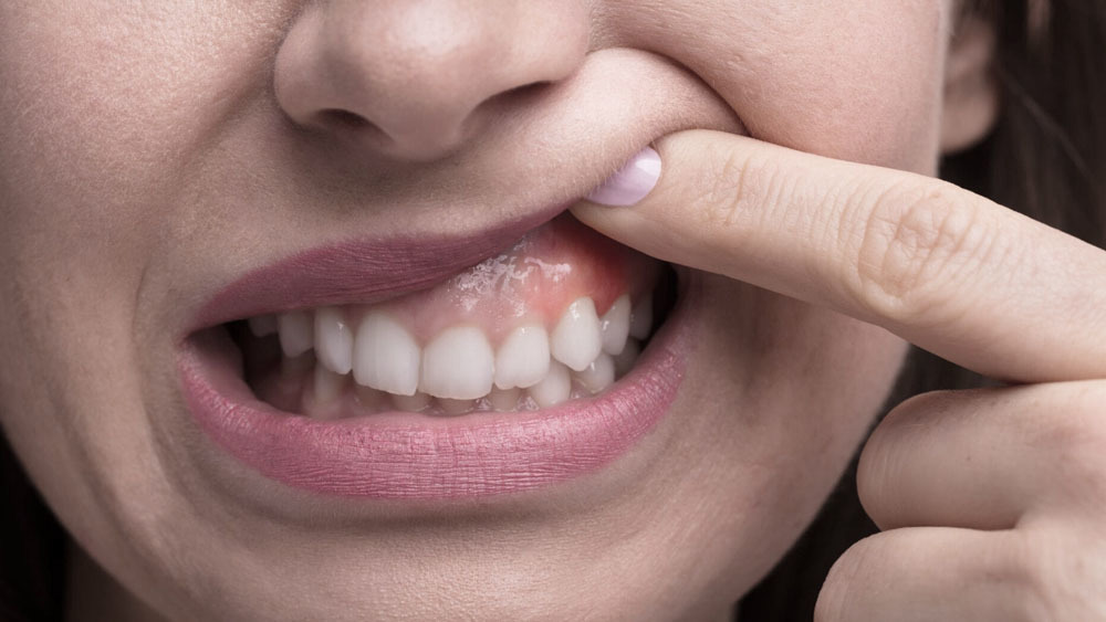 How Diabetes Affects Your Teeth and Gums