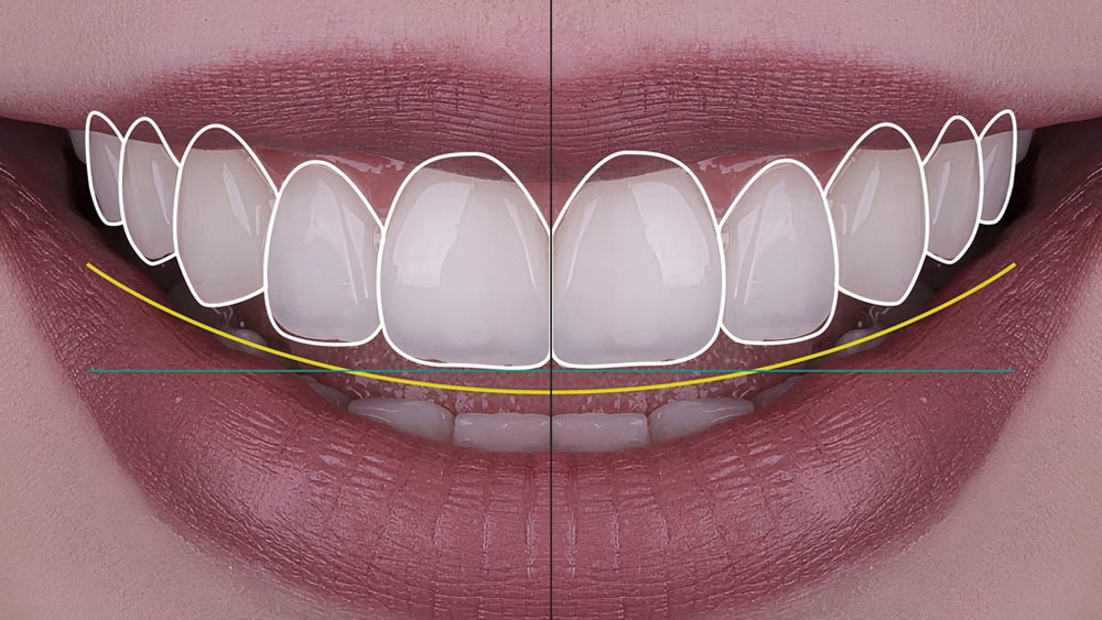 Smile Makeover: Transforming Your Smile and Confidence