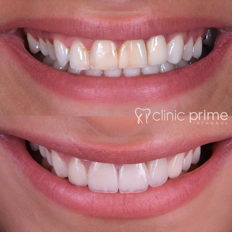 Hollywood Smile in Clinic Prime Istanbul