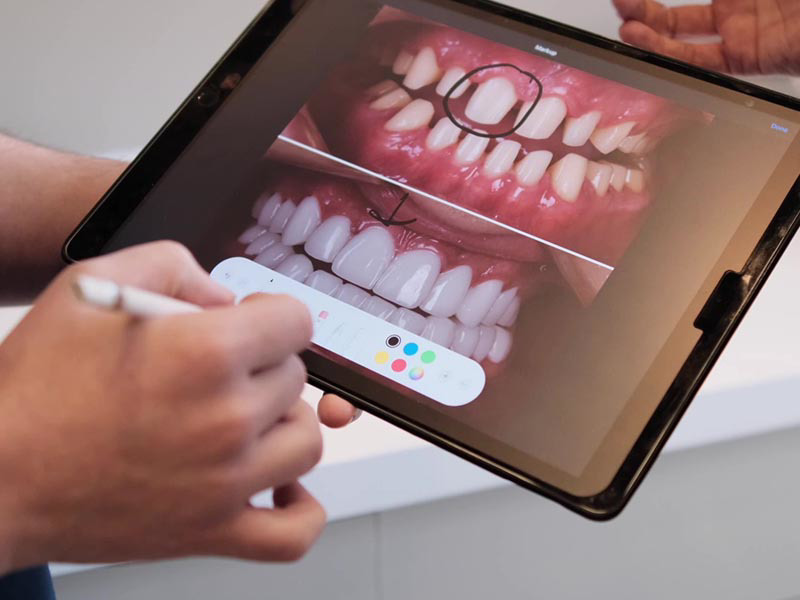 Smile Design