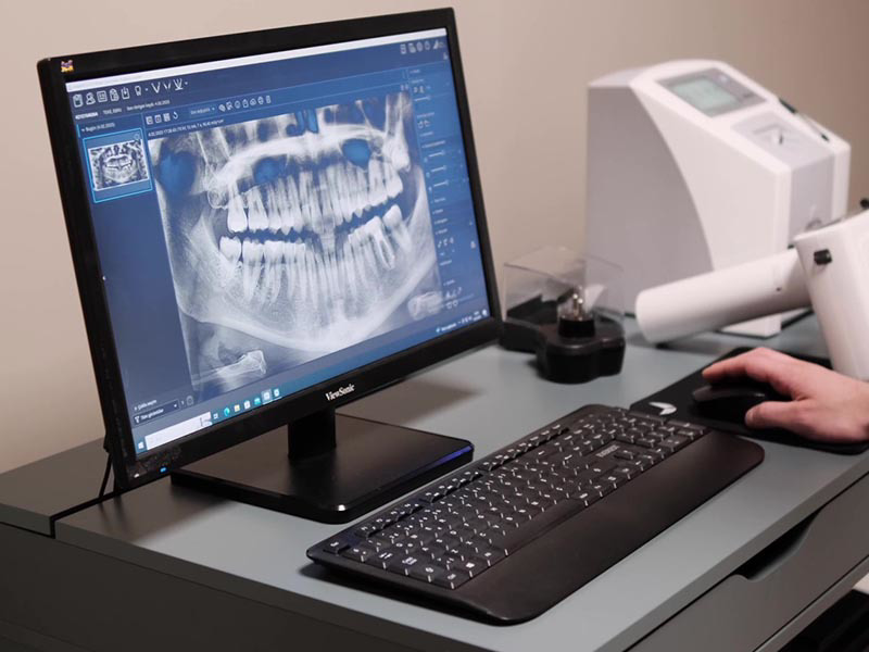 Root Canal Treatment