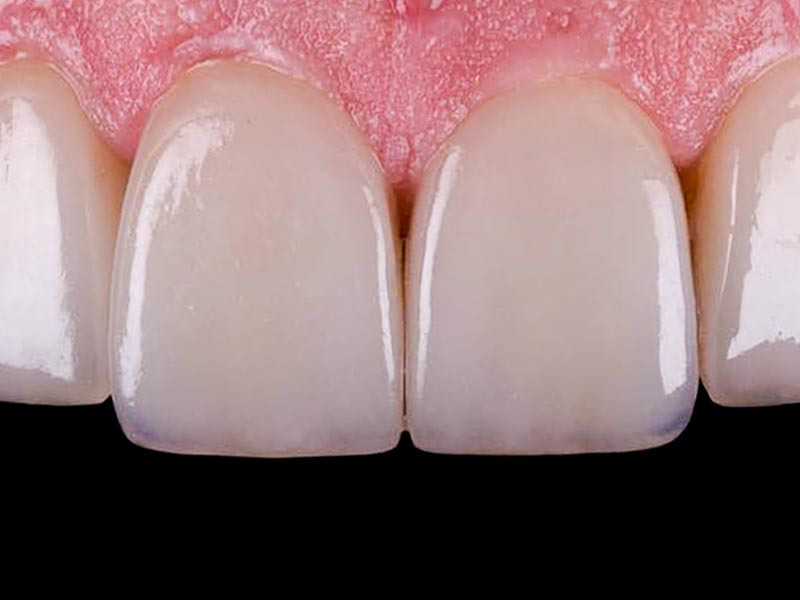 E-Max Laminate Veneers