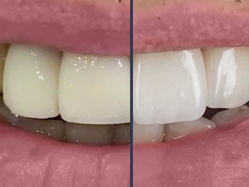 Zirconium Crowns 