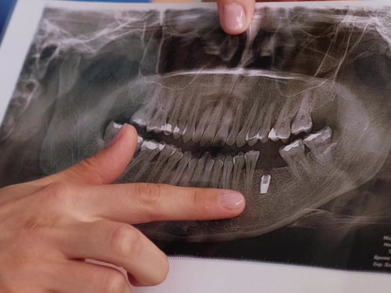 Dental Implants
