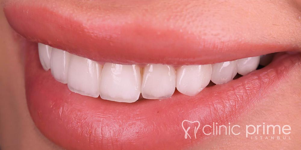 E-Max Treatment Istanbul
