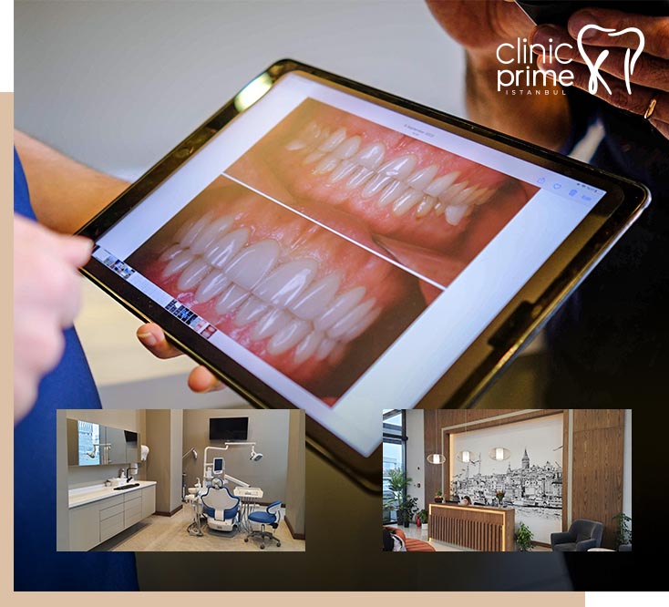 Hollywood Smile Design