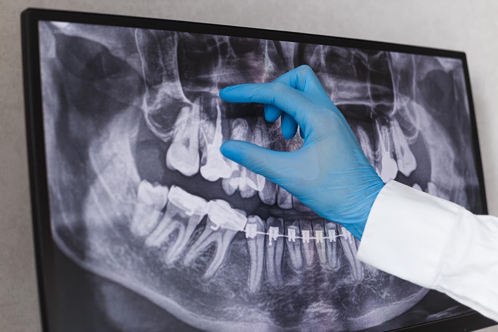 Root Canal Treatment